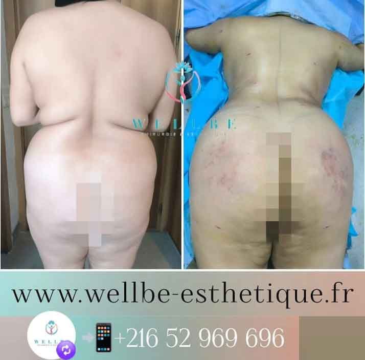 liposuccion vaser tunisie avant apres